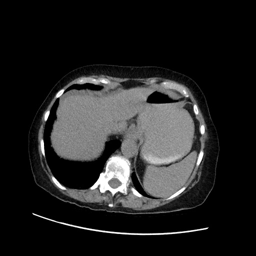 Closed loop small bowel obstruction due to adhesive band, with intramural hemorrhage and ischemia (Radiopaedia 83831-99017 Axial non-contrast 35).jpg