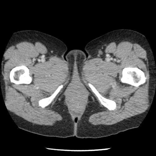 File:Closed loop small bowel obstruction due to trans-omental herniation (Radiopaedia 35593-37109 A 93).jpg