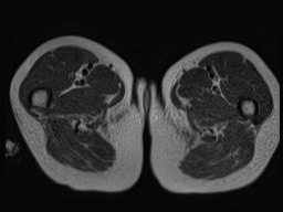 Closed loop small bowel obstruction in pregnancy (MRI) (Radiopaedia 87637-104031 D 52).jpg