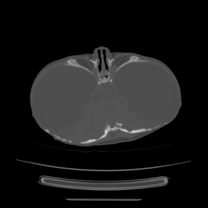 Cloverleaf skull (Radiopaedia 91901-109710 Axial bone window 61).jpg