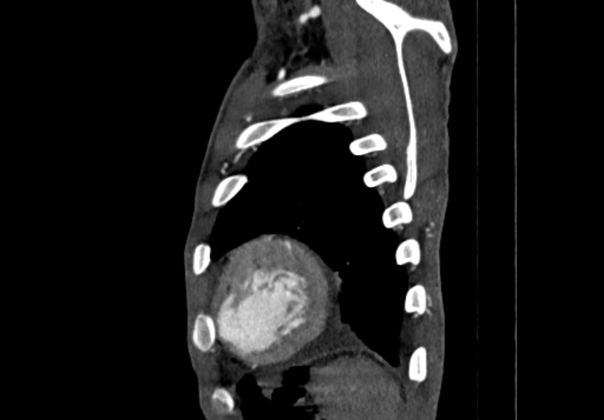 Coarctation of aorta with aortic valve stenosis (Radiopaedia 70463-80574 B 217).jpg