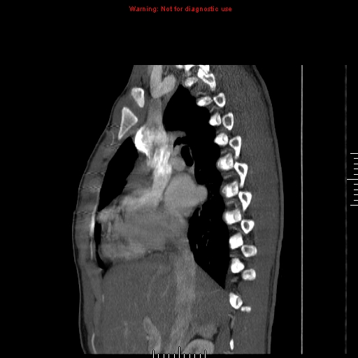 Coarctation of the aorta (Radiopaedia 9434-10118 B 20).jpg