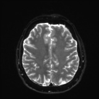 File:Cochlear incomplete partition type III associated with hypothalamic hamartoma (Radiopaedia 88756-105498 Axial DWI 29).jpg