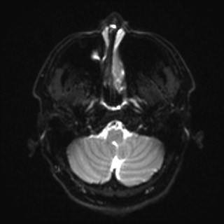Cochlear incomplete partition type III associated with hypothalamic hamartoma (Radiopaedia 88756-105498 Axial DWI 6).jpg