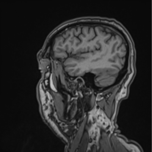File:Colloid cyst of the third ventricle (Radiopaedia 86571-102662 Sagittal T1 62).png