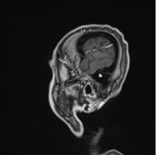 File:Colloid cyst of the third ventricle (Radiopaedia 86571-102662 Sagittal T1 C+ 8).png