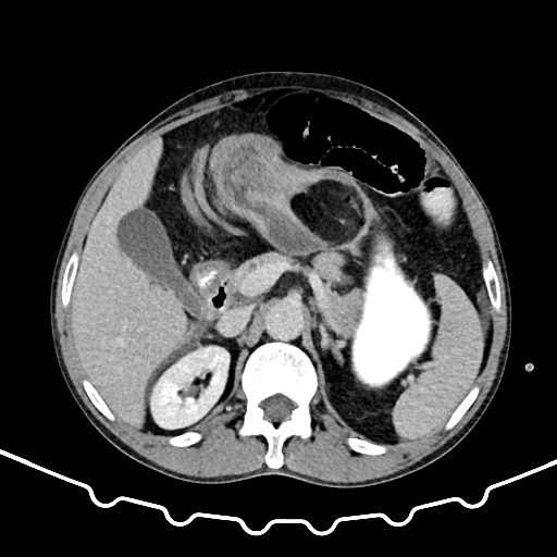 Colocolic intussusception due to large lipoma (Radiopaedia 68773-78482 A 51).jpg