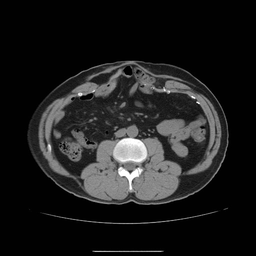 File:Colocutaneous fistula in Crohn's disease (Radiopaedia 29586-30093 Axial non-contrast 6).jpg