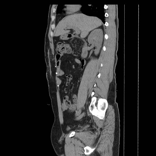 File:Colocutaneous fistula in Crohn's disease (Radiopaedia 29586-30093 C 13).jpg