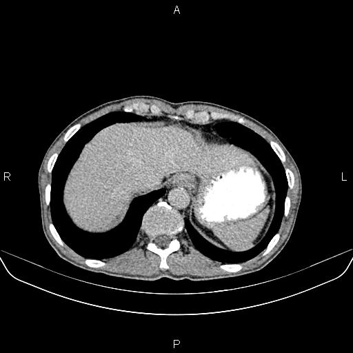 File:Colon adenocarcinoma - hepatic flexure (Radiopaedia 85635-101395 Axial C+ delayed 12).jpg
