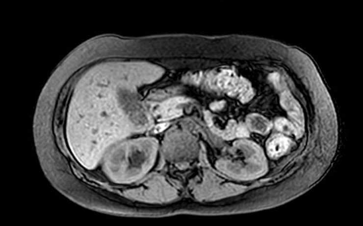 Colon adenocarcinoma with Krukenberg tumors, advanced pregnancy (Radiopaedia 67279-76645 A 56).jpg