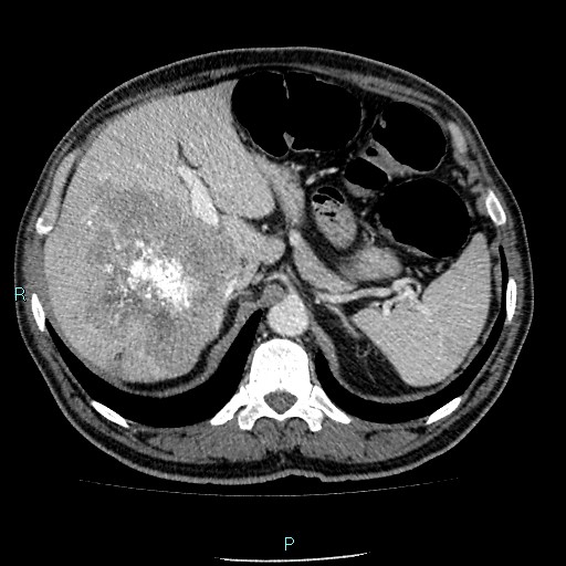 Colon adenocarcinoma with calcific liver metastasis (Radiopaedia 55745-62300 B 9).jpg