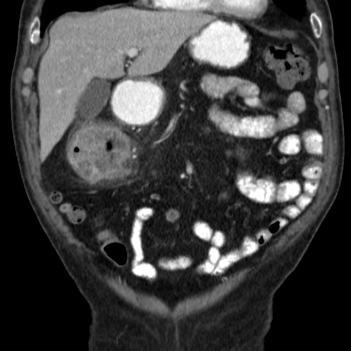 File:Colon cancer with duodenal invasion (Radiopaedia 16278-15958 B 18).jpg