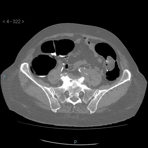 Colonic lipomas (Radiopaedia 49137-54244 Axial bone window 144).jpg