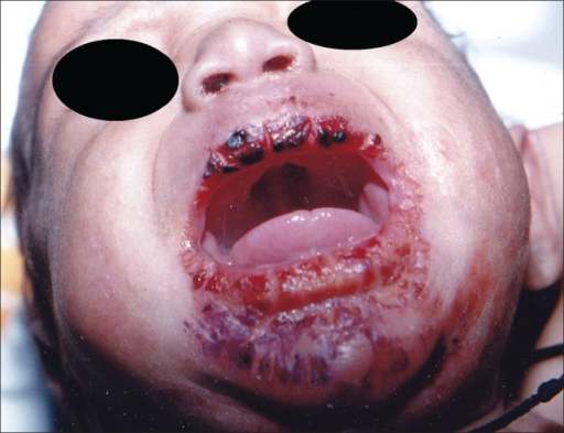 File:Congenital syphilis. High arched palate with oral erosions.png