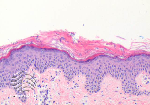 File:Figure 2 (DermNet NZ pathology-t-PVFigure2).jpg