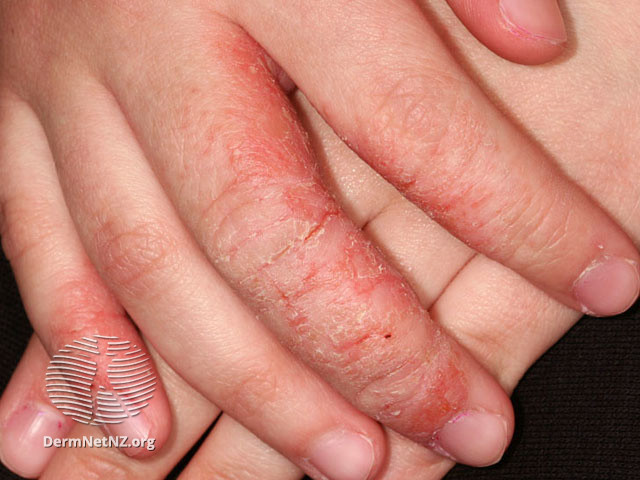 File:Finger eczema (DermNet NZ dermatitis-s-atopic16).jpg