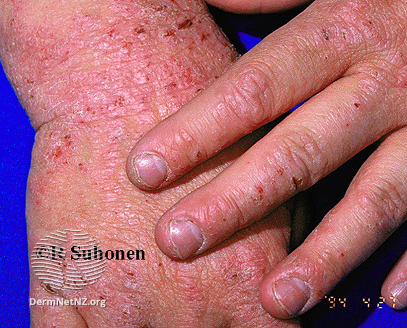 File:Hand eczema (DermNet NZ dermatitis-s-atopic4).jpg