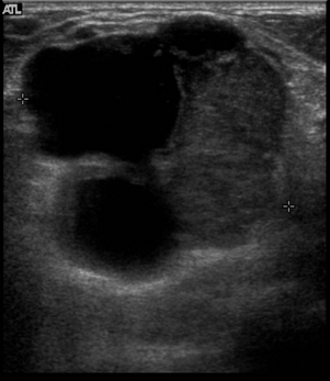 File:Intracystic breast carcinoma (Radiopaedia 18956).png