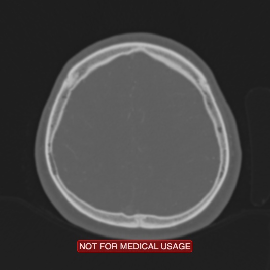 Nasopharyngeal carcinoma recurrence - skull base destruction (Radiopaedia 29107-29490 Axial bone window 27).jpg