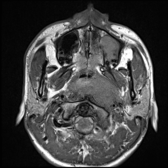 Nasopharyngeal carcinoma with skull base invasion (Radiopaedia 53415-59485 Axial T1 32).jpg
