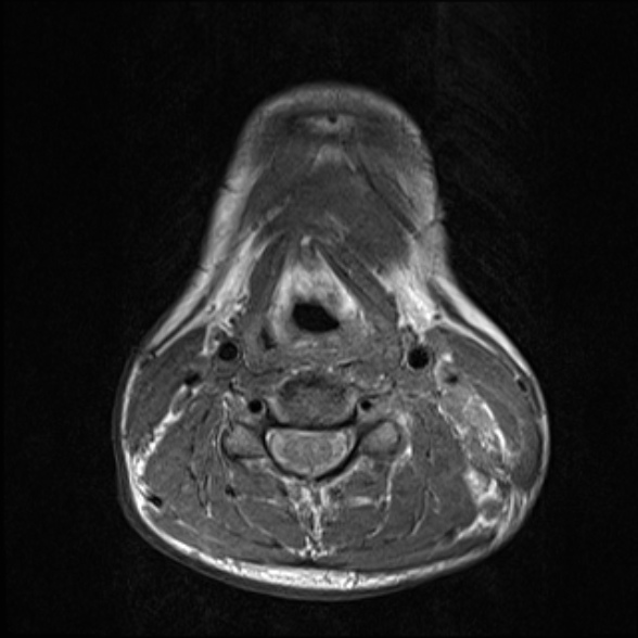 Nasopharyngeal carcinoma with skull base invasion (Radiopaedia 53415-59485 Axial T1 54).jpg