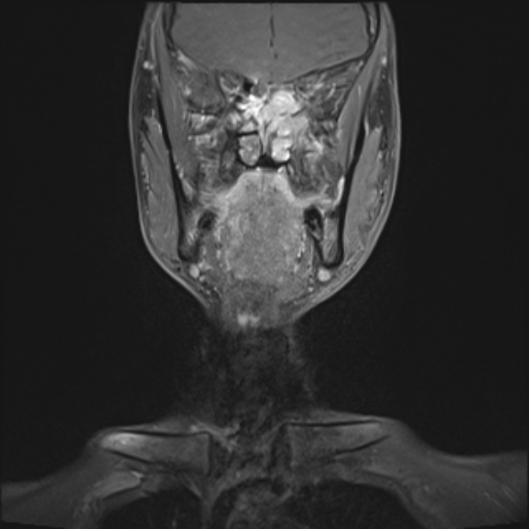 Nasopharyngeal carcinoma with skull base invasion (Radiopaedia 53415-59485 E 27).jpg