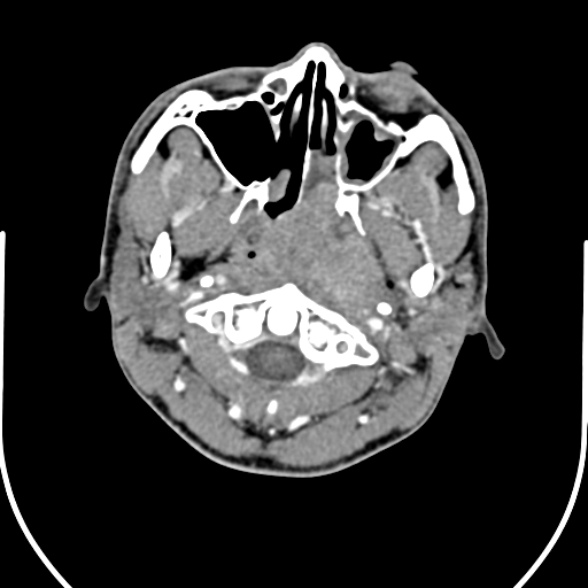 Nasopharyngeal carcinoma with skull base invasion (Radiopaedia 53415-59705 A 47).jpg