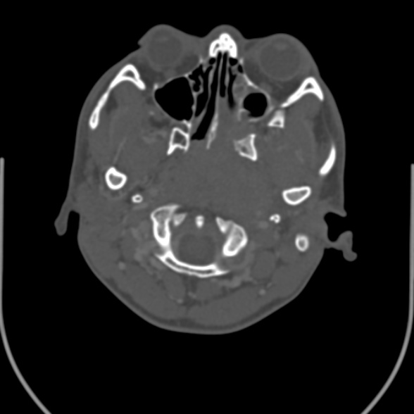 Nasopharyngeal carcinoma with skull base invasion (Radiopaedia 53415-59705 Axial bone window 37).jpg