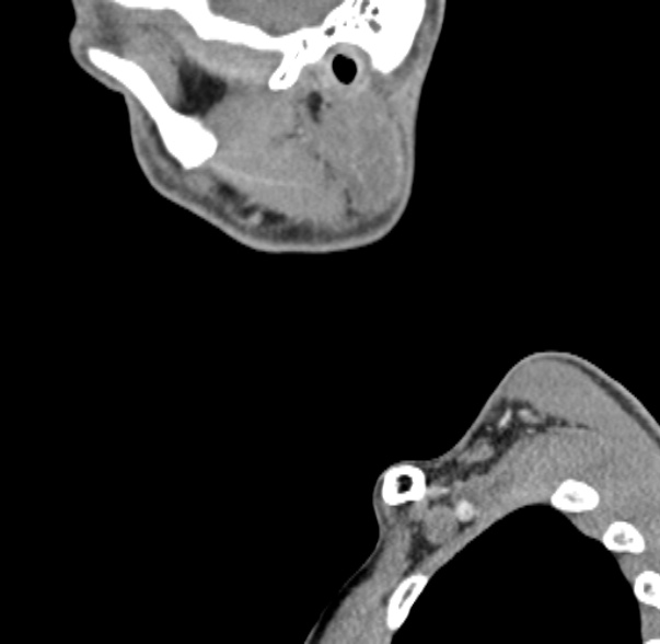 Nasopharyngeal carcinoma with skull base invasion (Radiopaedia 53415-59705 C 67).jpg