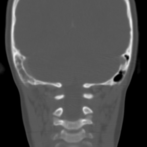 File:Nasopharyngeal rhabdomyosarcoma (Radiopaedia 23417-23491 Coronal bone window 14).jpg