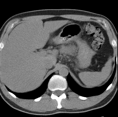 File:Necrotizing pancreatitis with acute necrotic collection (Radiopaedia 14470-14417 Axial non-contrast 5).jpg