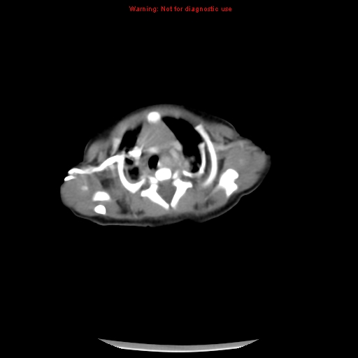 File:Neonatal neuroblastoma (Radiopaedia 9564-10223 A 3).jpg