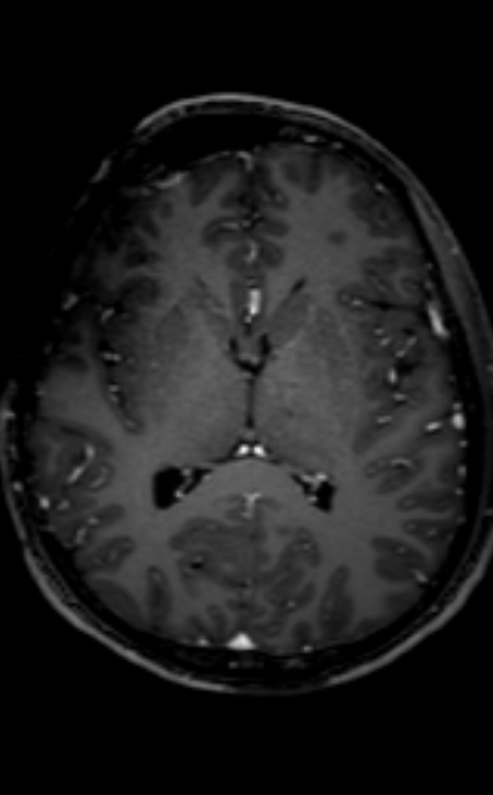 Neuro-Behçet disease (Radiopaedia 90112-107294 Axial T1 C+ 125).jpg