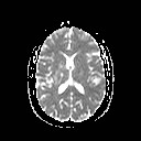 File:Neuro-Behcet's disease (Radiopaedia 21557-21505 Axial ADC 13).jpg