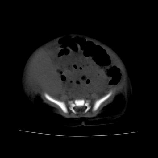 File:Neuroblastoma (Radiopaedia 20876-20799 Axial non-contrast 19).jpg