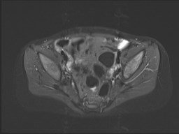 File:Neuroblastoma with bone metastases (Radiopaedia 67080-76414 Axial STIR 53).jpg