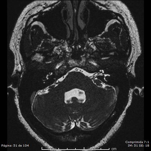 Neurocysticercosis (Radiopaedia 58636-65832 I 51).jpg
