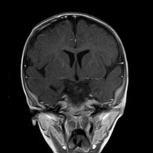 File:Neurofibromatosis type 1 (Radiopaedia 30089-30671 Coronal T1 C+ 13).jpg