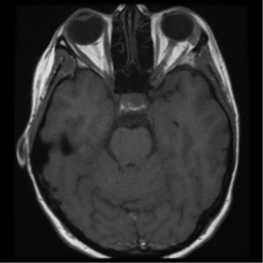 File:Neurofibromatosis type 2 - bilateral acoustic neuromata (Radiopaedia 40060-42566 Axial T1 11).png