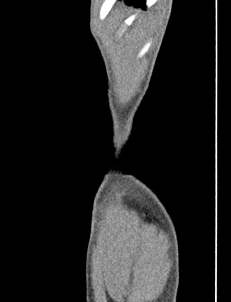 File:Neurogenic bladder (Radiopaedia 29058-29421 Coronal non-contrast 1).jpg