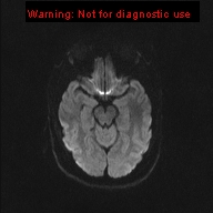 File:Neuroglial cyst (Radiopaedia 10713-11184 Axial DWI 37).jpg