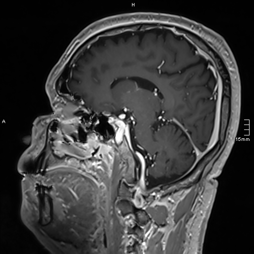Neurosarcoidosis - involvement of the mesial temporal lobes (Radiopaedia 67429-76820 Sagittal T1 C+ 97).jpg