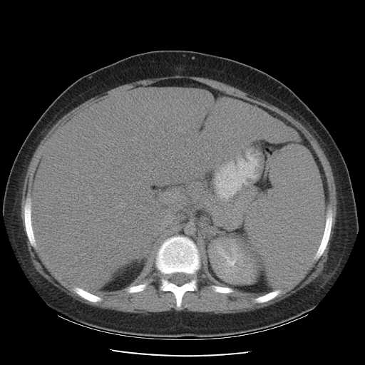 File:Non-Hodgkin lymphoma involving pelvis (Radiopaedia 21281-21197 B 23).jpg
