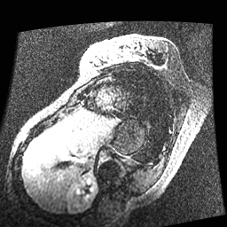 File:Non-compaction of the left ventricle (Radiopaedia 38868-41062 E 4).jpg