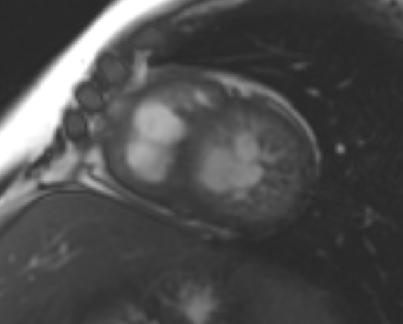 File:Non-compaction of the left ventricle (Radiopaedia 69436-79314 Short axis cine 109).jpg