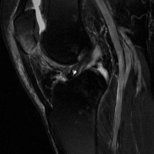 File:Non-displaced patella fracture (Radiopaedia 15932-15582 Sagittal T2 fat sat 10).jpg