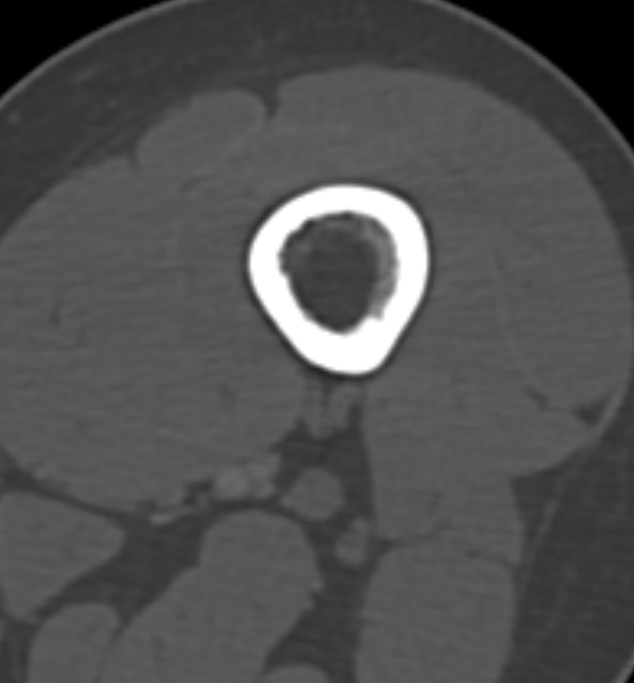 Non-ossifying fibroma - femur (Radiopaedia 82786-97042 Axial bone window 23).jpg