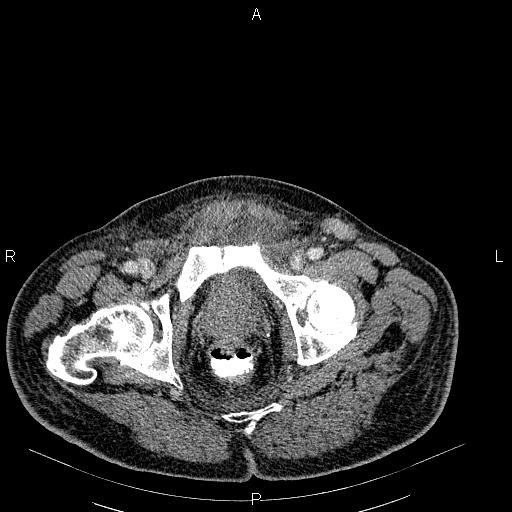 File:Non Hodgkin lymphoma in a patient with ankylosing spondylitis (Radiopaedia 84323-99621 B 62).jpg