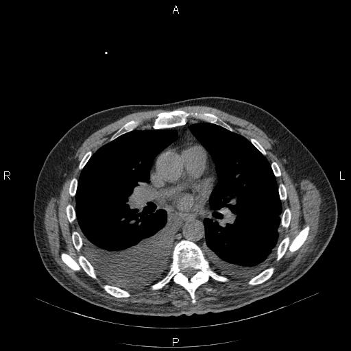 File:Non Hodgkin lymphoma in a patient with ankylosing spondylitis (Radiopaedia 84323-99624 Axial non-contrast 18).jpg